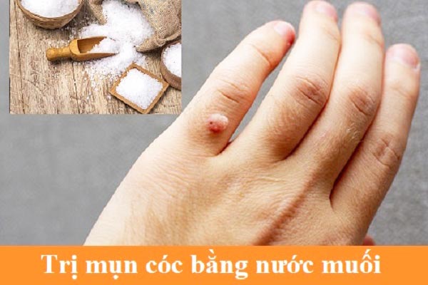Nước muối giúp trị mụn cóc