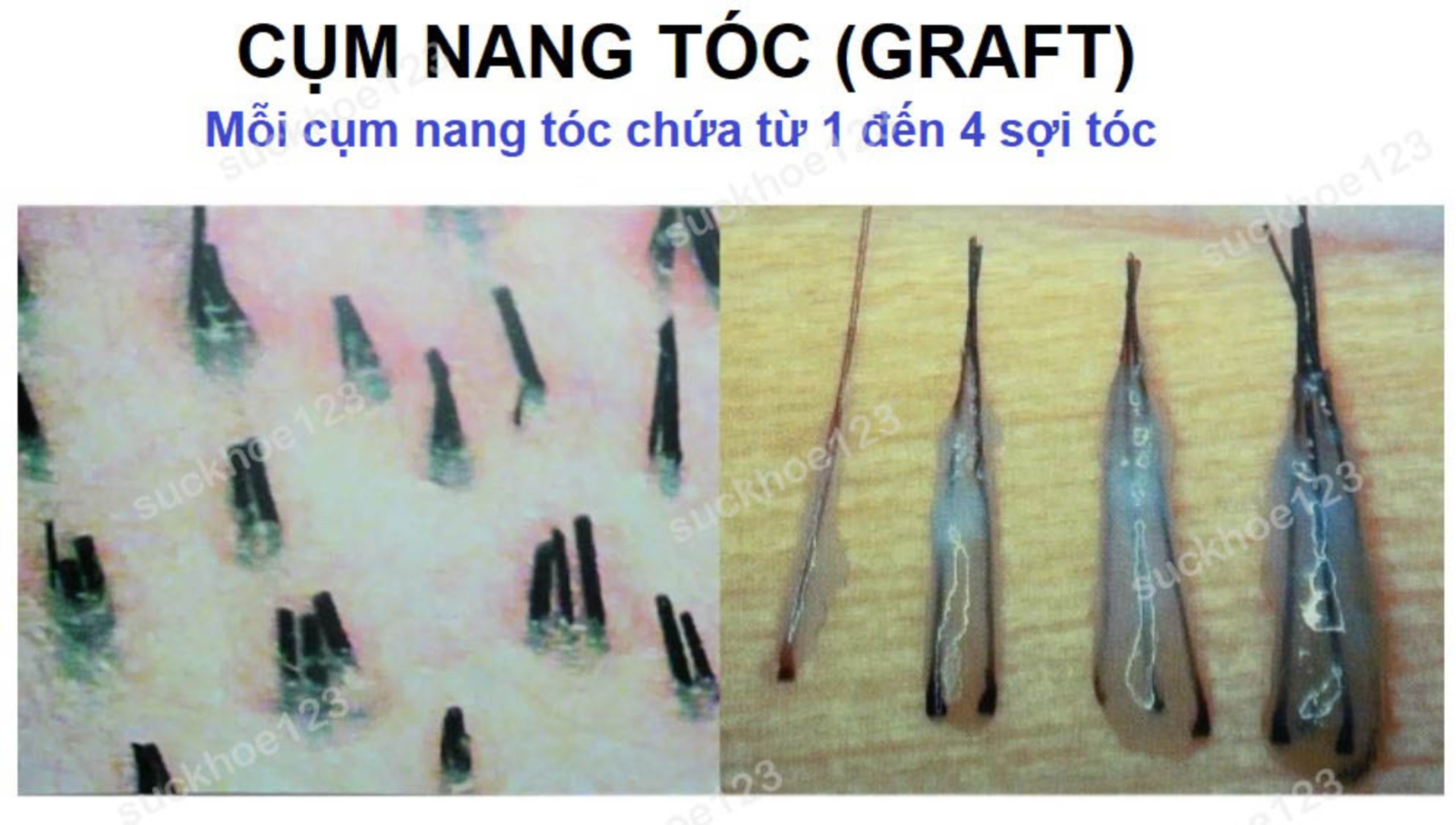 Các nang trứng bắt đầu hình thành