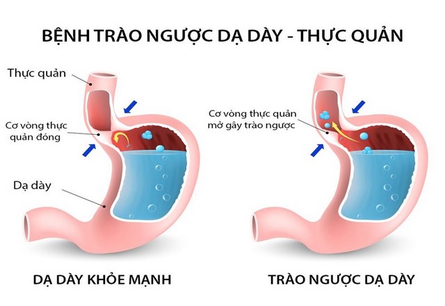 bệnh trào ngược dạ dày