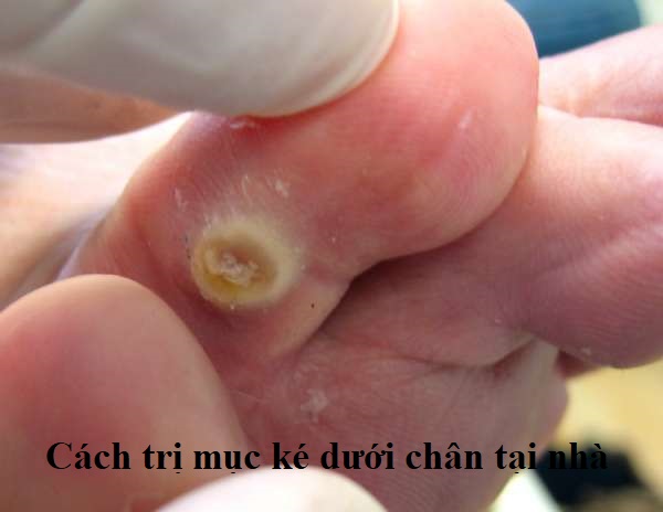 Cách trị mục ké dưới chân tại nhà