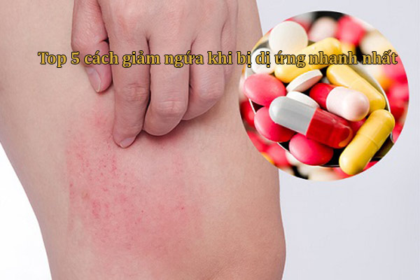 Nguyên nhân gây ngứa khi bị dị ứng