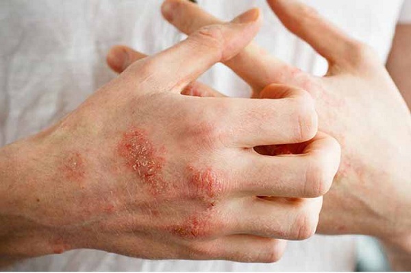 Triệu chứng bệnh chàm khô