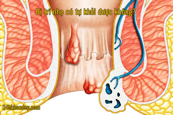 Bị trĩ nhẹ có tự khỏi được không