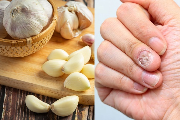 Chữa nấm móng tay bằng tỏi