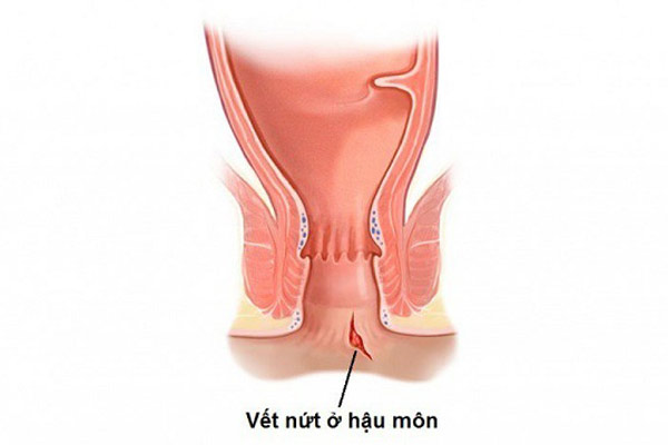 Hình ảnh bệnh nứt kẽ hậu môn