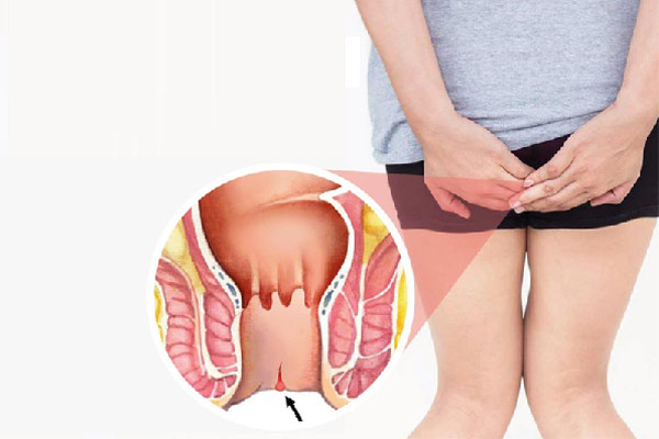 Hình ảnh bệnh nứt kẽ hậu môn