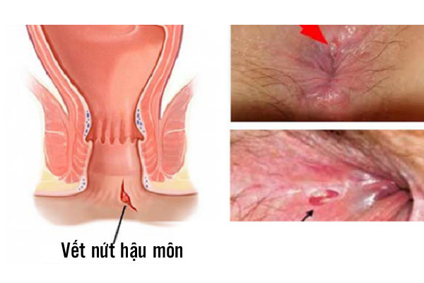 Nứt kẽ hậu môn
