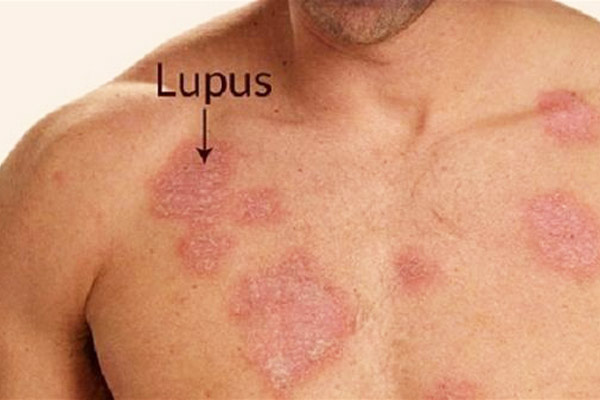 lupus ban đỏ