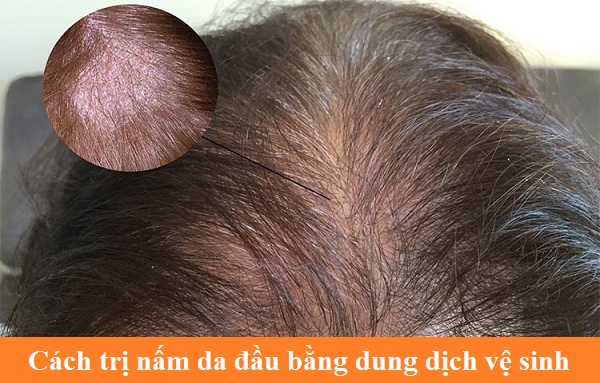 Cách trị nấm da đầu bằng dung dịch vệ sinh