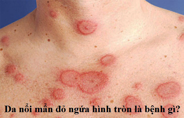 Da nổi mẩn đỏ ngứa hình tròn