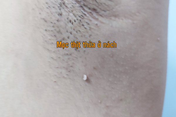 Mọc thịt thừa ở nách