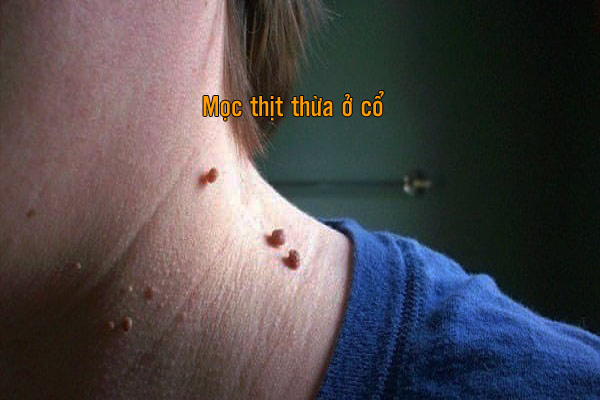 Mọc thịt thừa ở vùng cổ