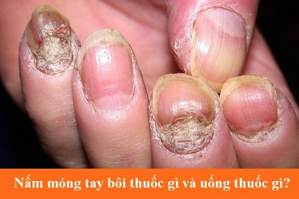 Nấm móng tay bôi thuốc gì