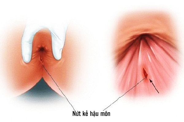 Nứt kẽ hậu môn
