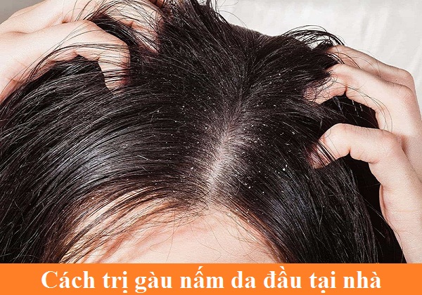 cách trị gàu nấm da đầu tại nhà