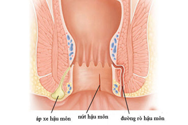 rò hậu môn