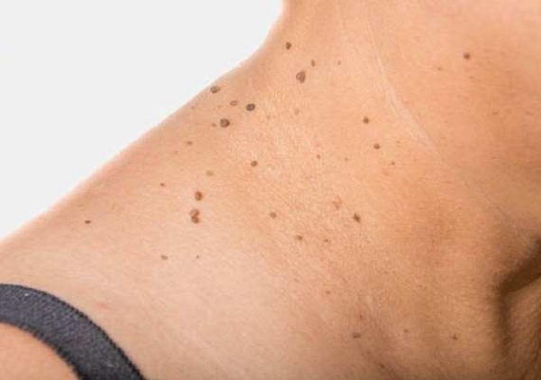 Xuất hiện thịt thừa trên da