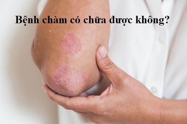 Bệnh chàm hoàn toàn có thể chữa khỏi