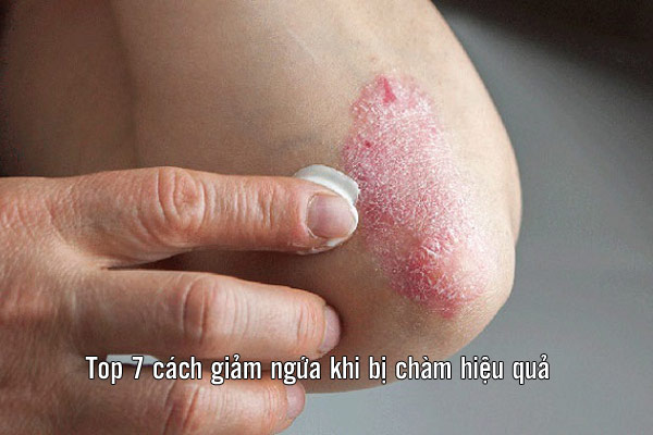 Sử dụng thuốc trị chàm da