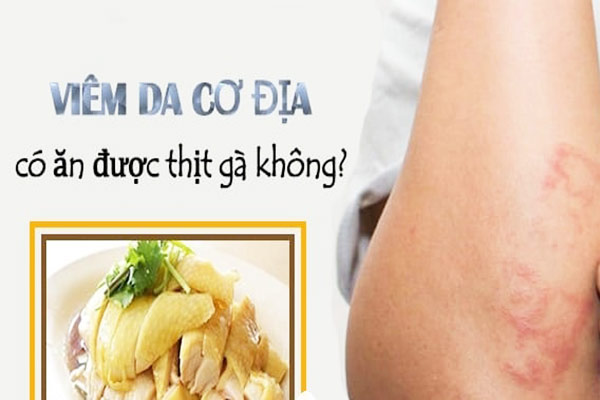 Viêm da cơ địa có ăn được thịt gà không?