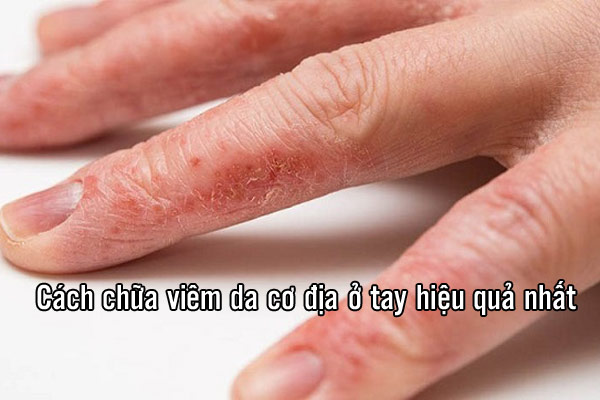 Viêm da cơ địa ở tay