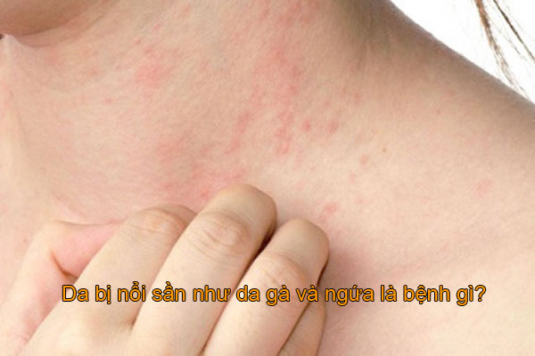 Da bị nổi sần như da gà và ngứa