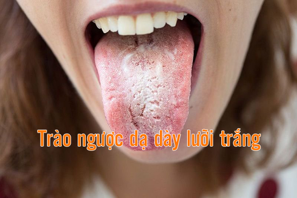 trào ngược dạ dày lưỡi trắng