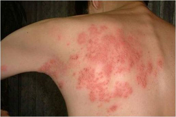 Viêm da dị ứng khiến lưng nổi sần ngứa