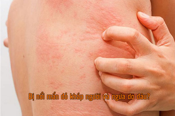 bị nổi mẩn đỏ khắp người và ngứa