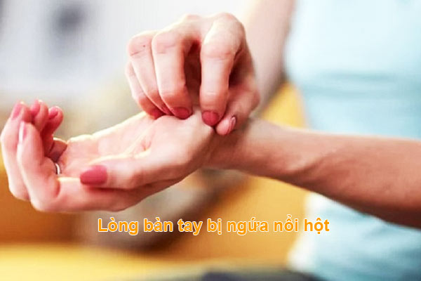 Mề đay mẩn ngứa