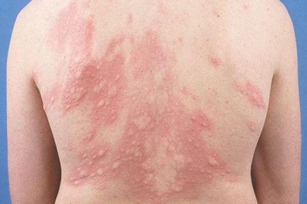 Nổi mề đay gây nổi mẩn đỏ
