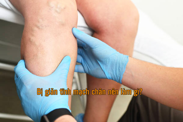Bị giãn tĩnh mạch chân nên làm gì?