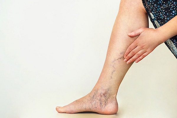 “giãn tĩnh mạch có chạy bộ được không