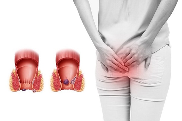 Bệnh trĩ gây ra tình trạng đi cầu ra máu