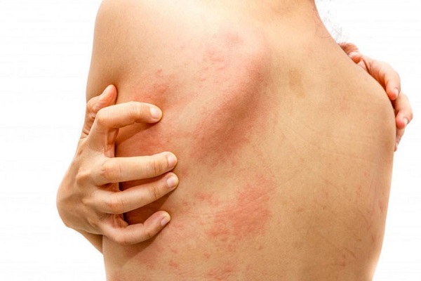 Bị dị ứng ngứa khắp người phải làm sao
