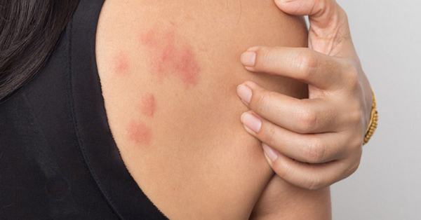 bị nổi vòng tròn đỏ trên da