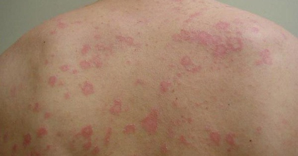 Bị nổi vòng tròn đỏ trên da và ngứa