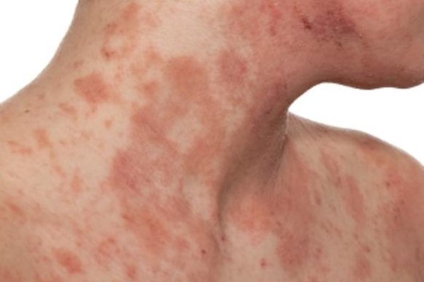 Biểu hiện viêm da cơ địa ở người lớn