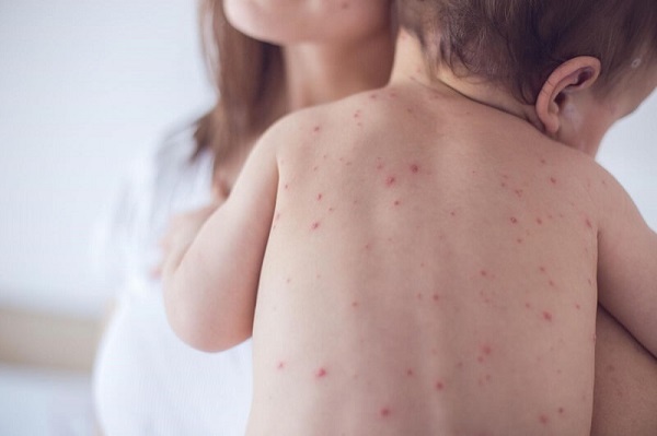 Biểu hiện viêm da cơ địa ở trẻ em