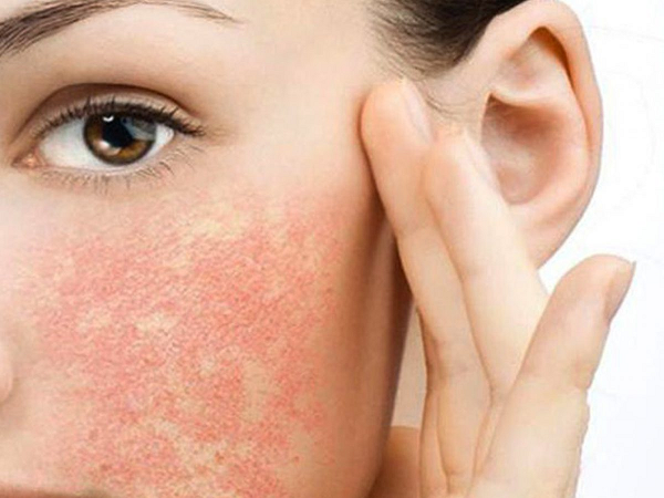 Da bị kích ứng mẩn đỏ