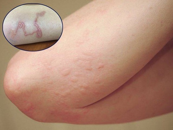 Trẻ bị nhiễm giun sán