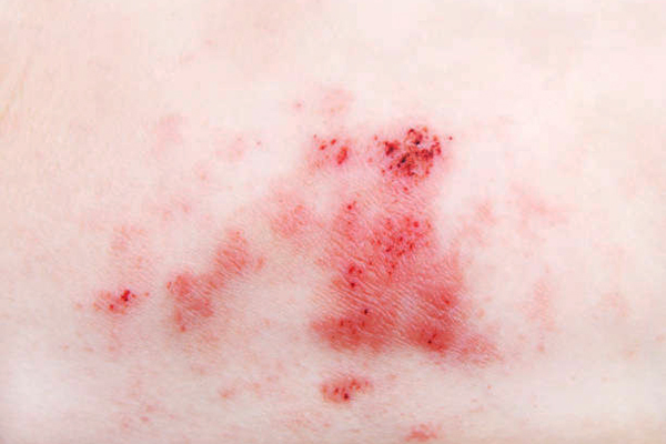 Thuốc bôi chữa viêm da cơ địa ở trẻ em