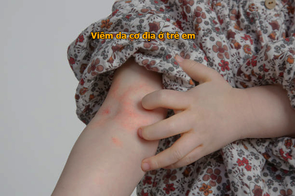 Viêm da cơ địa ở trẻ em