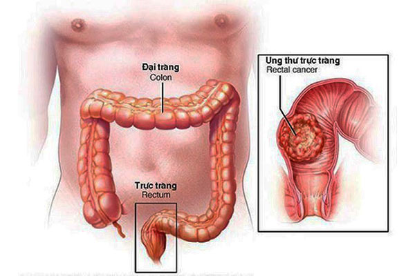 Viêm trực tràng