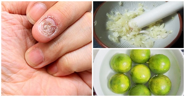 Chữa nấm móng tay nhanh chóng bằng chanh và tỏi