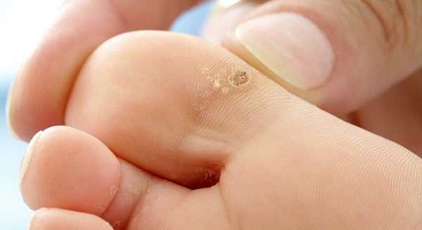 Hình ảnh mụn cóc ở ngón chân