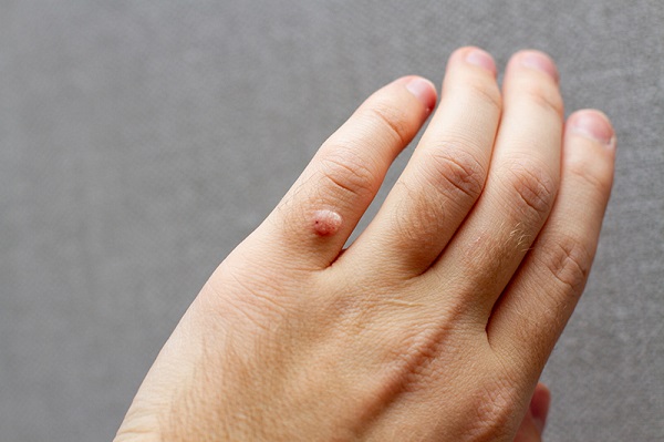 Hình ảnh mụn cóc ở ngón tay