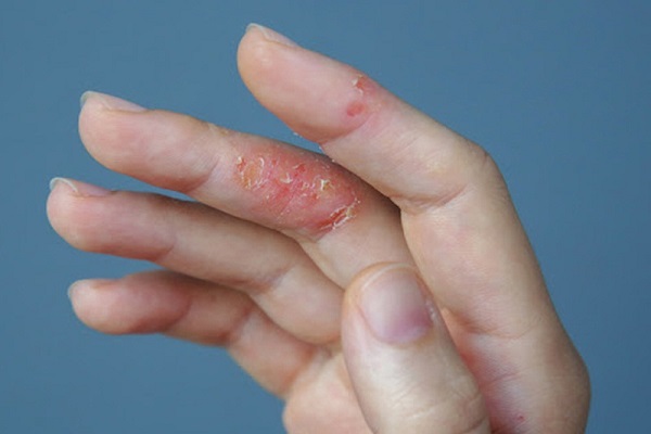 Triệu chứng của viêm da cơ địa