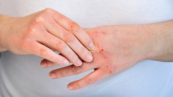 Viêm da cơ địa có tính di truyền
