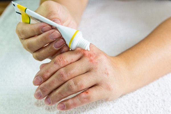 bị viêm da cơ địa khi giao mùa